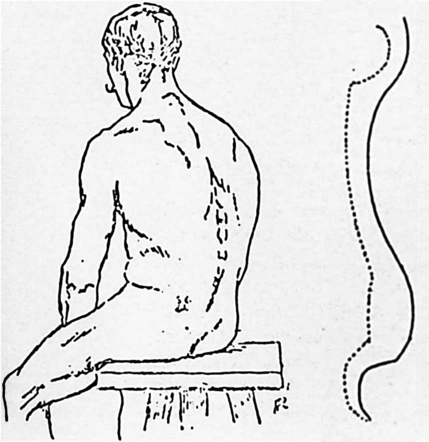 《脊椎的病理学弯曲》，Paul Richier；图中，虚线表示病人脊椎曲线，与旁边代表标准的曲线相比较